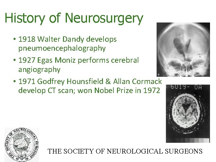 History of Neurosurgery • 1918 Walter Dandy develops pneumoencephalography • 1927 Egas Moniz performs