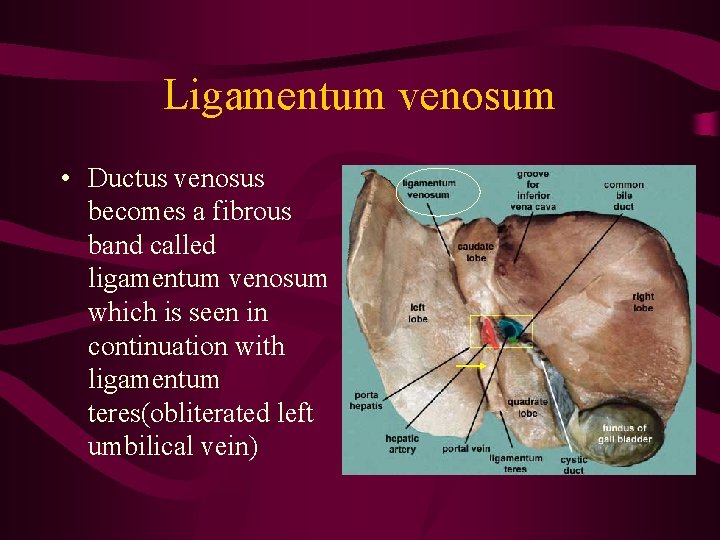 Ligamentum venosum • Ductus venosus becomes a fibrous band called ligamentum venosum which is