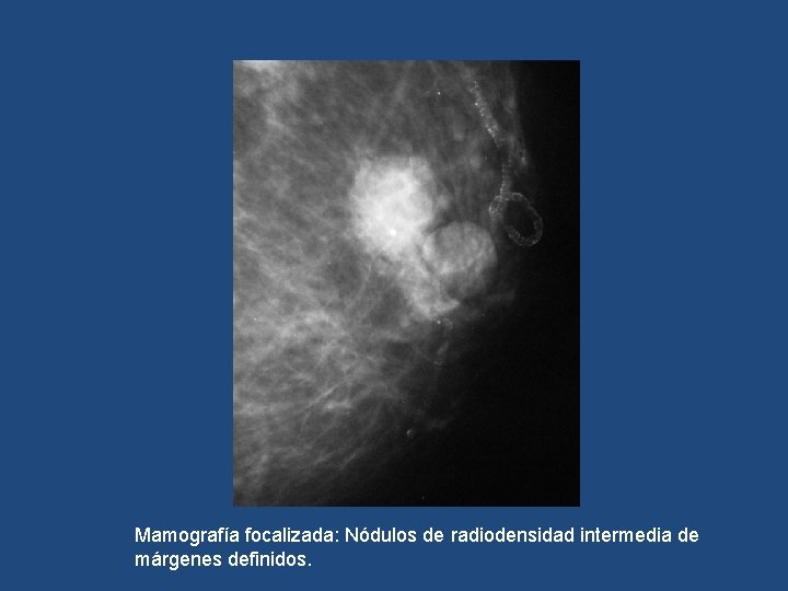 Mamografía focalizada: Nódulos de radiodensidad intermedia de márgenes definidos. 