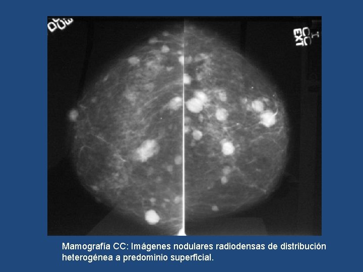 Mamografía CC: Imágenes nodulares radiodensas de distribución heterogénea a predominio superficial. 