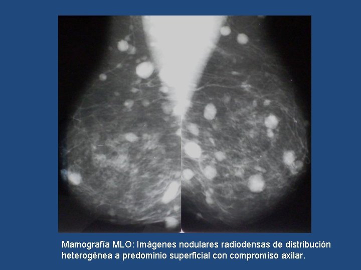 Mamografía MLO: Imágenes nodulares radiodensas de distribución heterogénea a predominio superficial con compromiso axilar.