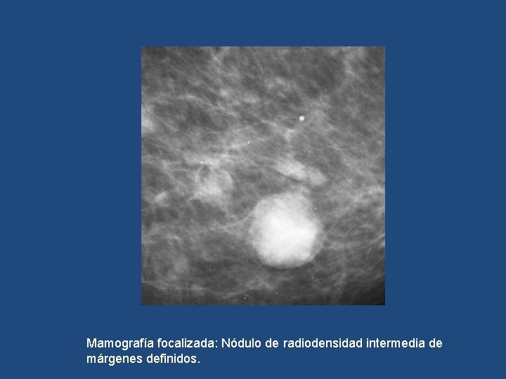 Mamografía focalizada: Nódulo de radiodensidad intermedia de márgenes definidos. 