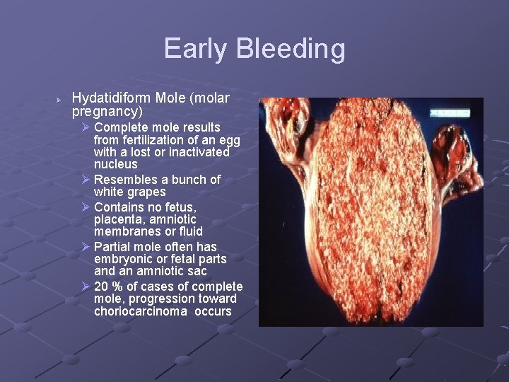 Early Bleeding Ø Hydatidiform Mole (molar pregnancy) Ø Complete mole results from fertilization of