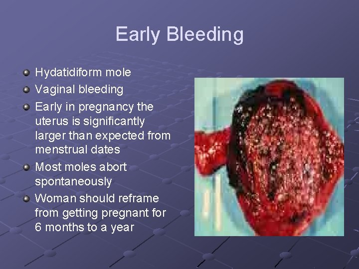 Early Bleeding Hydatidiform mole Vaginal bleeding Early in pregnancy the uterus is significantly larger