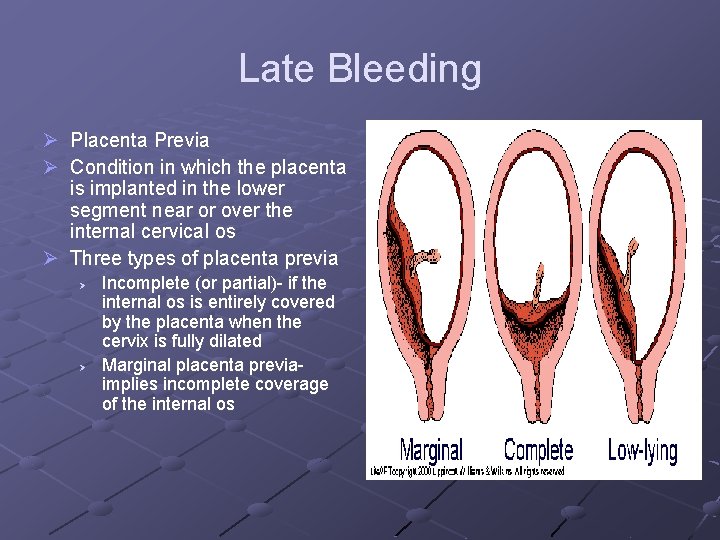 Late Bleeding Ø Placenta Previa Ø Condition in which the placenta is implanted in