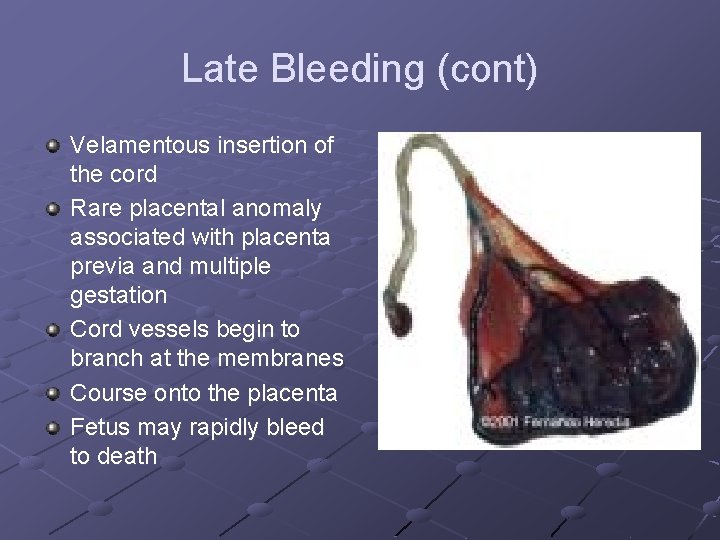 Late Bleeding (cont) Velamentous insertion of the cord Rare placental anomaly associated with placenta