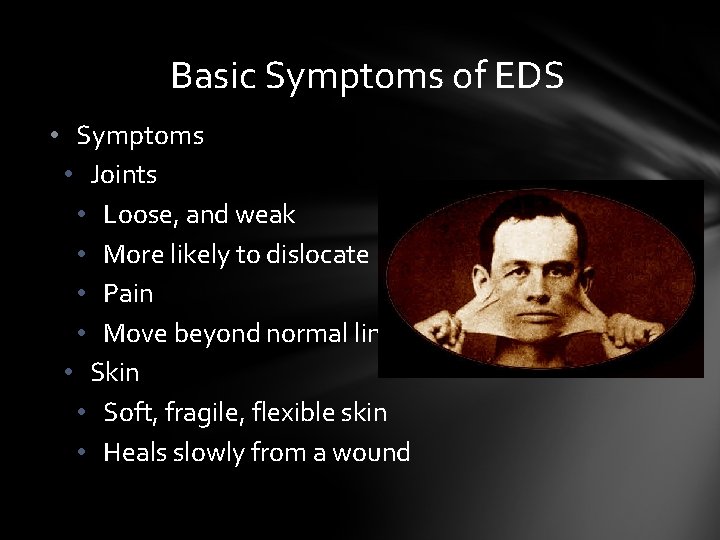 Basic Symptoms of EDS • Symptoms • Joints • Loose, and weak • More