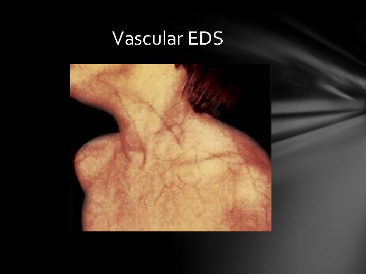 Vascular EDS 