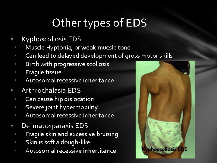 Other types of EDS Kyphoscoliosis EDS • • • Muscle Hyptonia, or weak mucsle