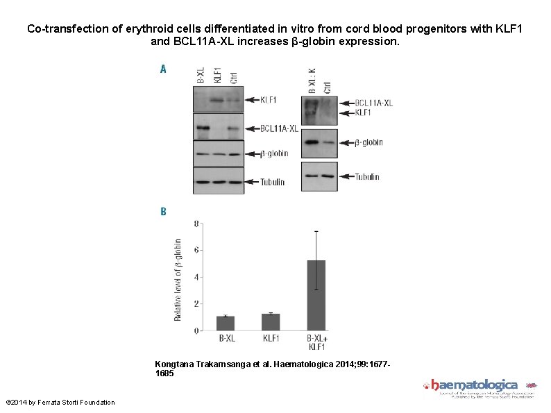 Co-transfection of erythroid cells differentiated in vitro from cord blood progenitors with KLF 1