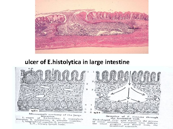 ulcer of E. histolytica in large intestine Fig 23 -A Fig 23 -B 
