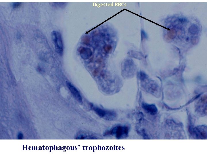 Digested RBCs Hematophagous’ trophozoites 