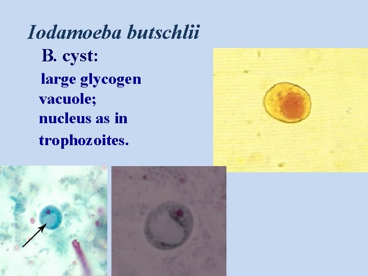 Iodamoeba butschlii B. cyst: large glycogen vacuole; nucleus as in trophozoites. 