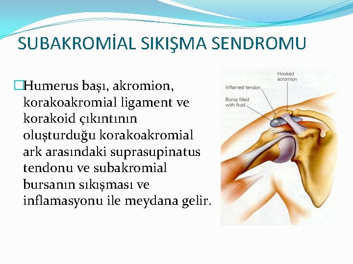 SUBAKROMİAL SIKIŞMA SENDROMU �Humerus başı, akromion, korakoakromial ligament ve korakoid çıkıntının oluşturduğu korakoakromial ark