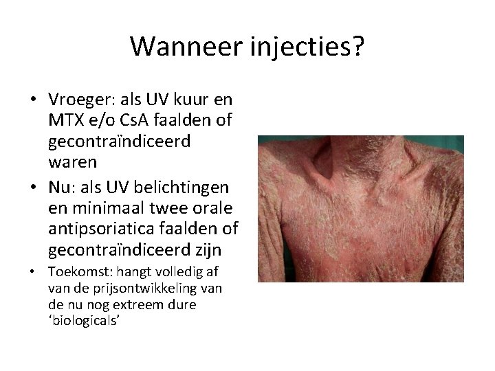 Wanneer injecties? • Vroeger: als UV kuur en MTX e/o Cs. A faalden of