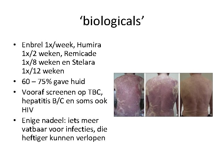 ‘biologicals’ • Enbrel 1 x/week, Humira 1 x/2 weken, Remicade 1 x/8 weken en