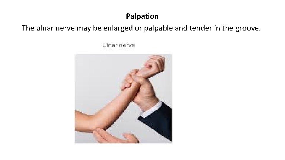 Palpation The ulnar nerve may be enlarged or palpable and tender in the groove.