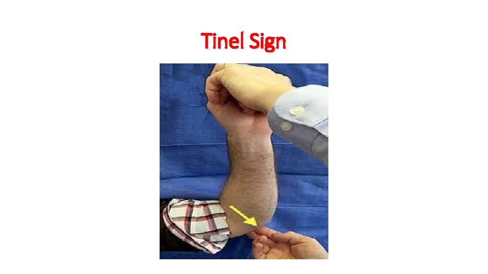 Tinel Sign 