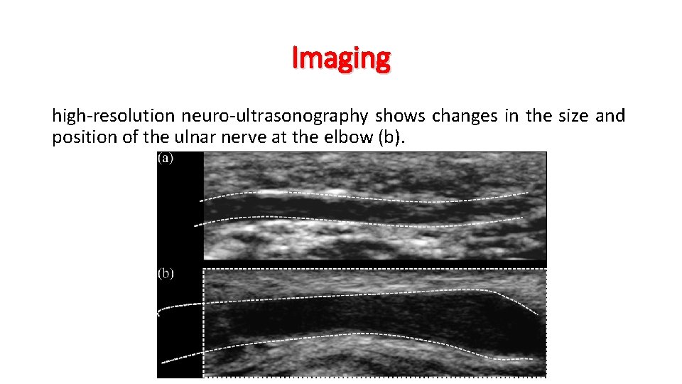 Imaging high-resolution neuro-ultrasonography shows changes in the size and position of the ulnar nerve
