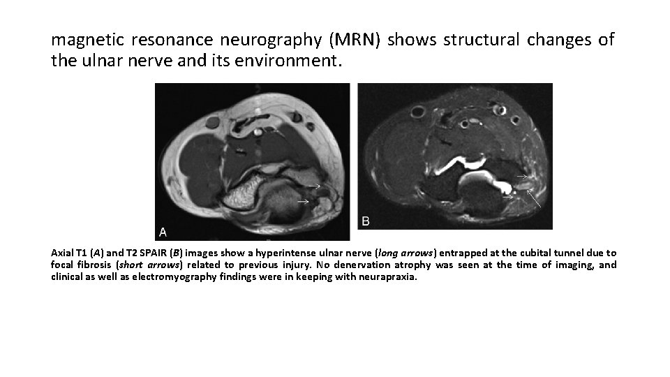magnetic resonance neurography (MRN) shows structural changes of the ulnar nerve and its environment.
