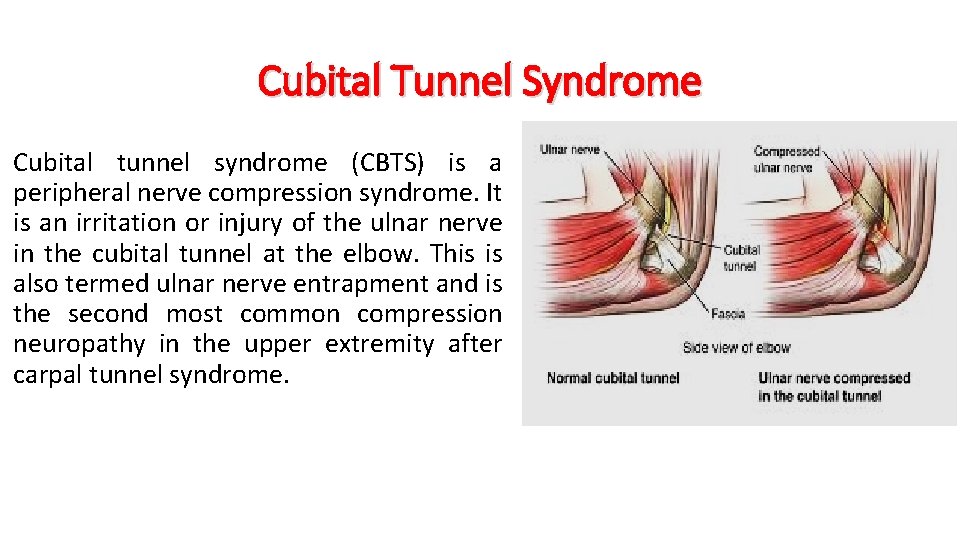 Cubital Tunnel Syndrome Cubital tunnel syndrome (CBTS) is a peripheral nerve compression syndrome. It