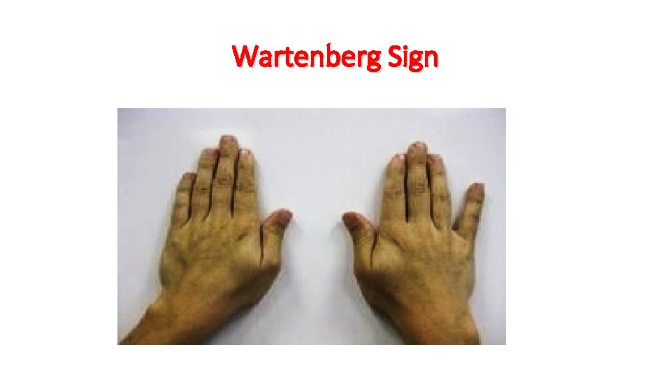 Wartenberg Sign 