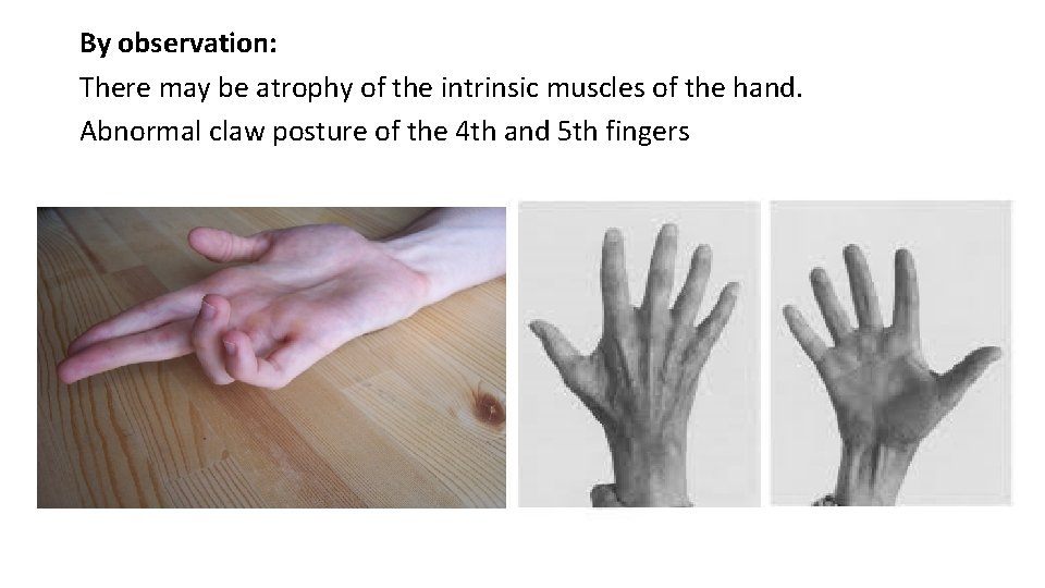By observation: There may be atrophy of the intrinsic muscles of the hand. Abnormal