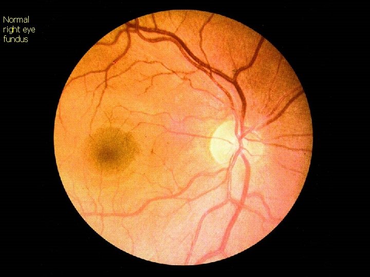 Normal right eye fundus 