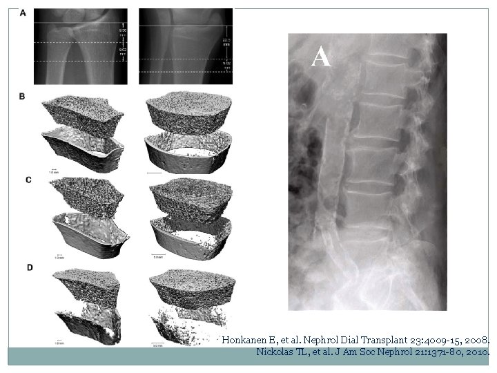 Honkanen E, et al. Nephrol Dial Transplant 23: 4009 -15, 2008. Nickolas TL, et