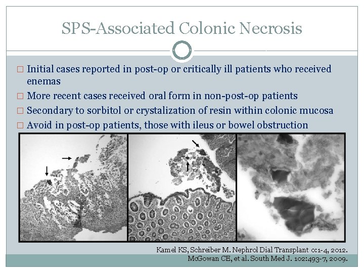 SPS-Associated Colonic Necrosis � Initial cases reported in post-op or critically ill patients who