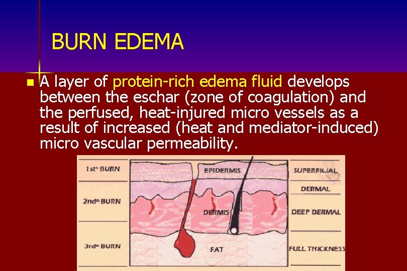 BURN EDEMA n A layer of protein-rich edema fluid develops between the eschar (zone
