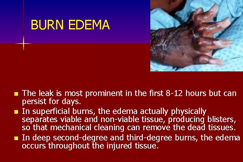 BURN EDEMA n n n The leak is most prominent in the first 8