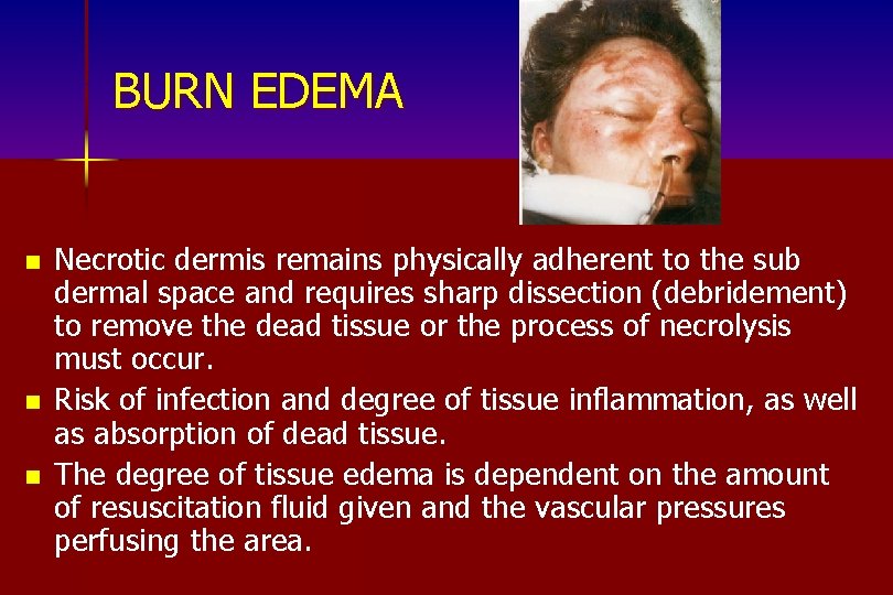 BURN EDEMA n n n Necrotic dermis remains physically adherent to the sub dermal