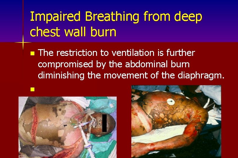 Impaired Breathing from deep chest wall burn n n The restriction to ventilation is