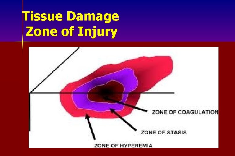Tissue Damage Zone of Injury 