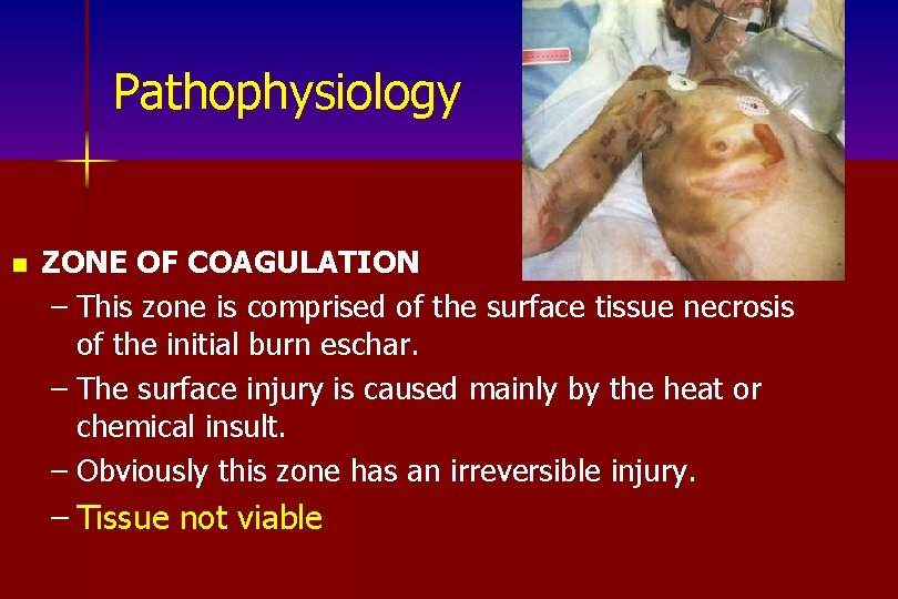 Pathophysiology n ZONE OF COAGULATION – This zone is comprised of the surface tissue