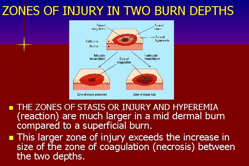 ZONES OF INJURY IN TWO BURN DEPTHS n THE ZONES OF STASIS OR INJURY