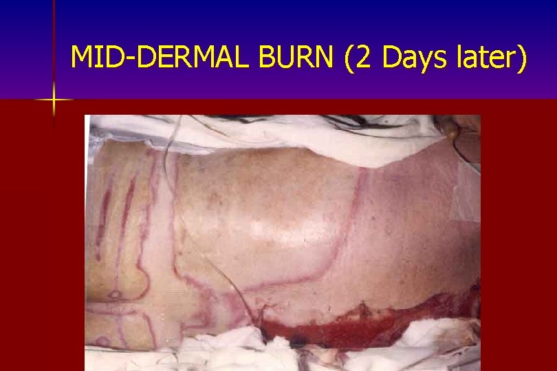 MID-DERMAL BURN (2 Days later) 