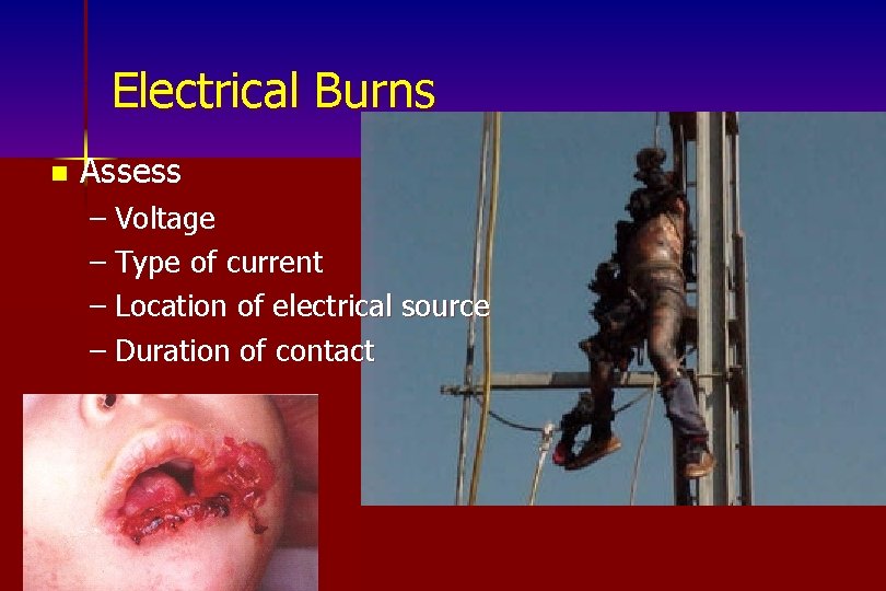 Electrical Burns n Assess – Voltage – Type of current – Location of electrical