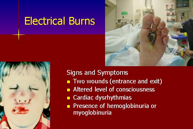 Electrical Burns Signs and Symptoms n n Two wounds (entrance and exit) Altered level