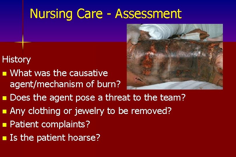 Nursing Care - Assessment History n What was the causative agent/mechanism of burn? n