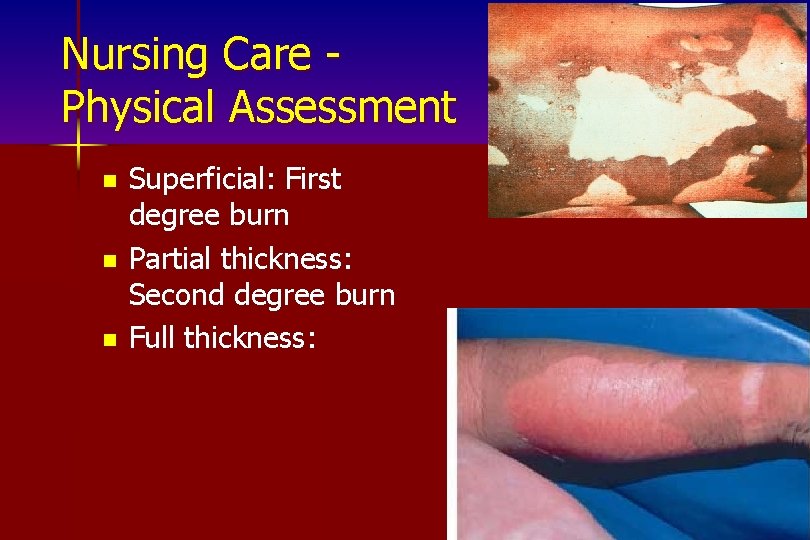 Nursing Care Physical Assessment n n n Superficial: First degree burn Partial thickness: Second