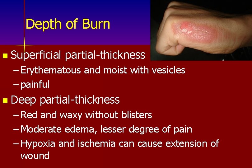 Depth of Burn n Superficial partial-thickness – Erythematous and moist with vesicles – painful