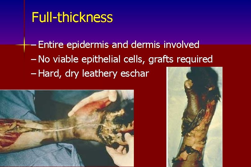 Full-thickness – Entire epidermis and dermis involved – No viable epithelial cells, grafts required