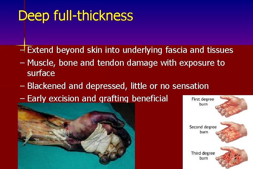 Deep full-thickness – Extend beyond skin into underlying fascia and tissues – Muscle, bone