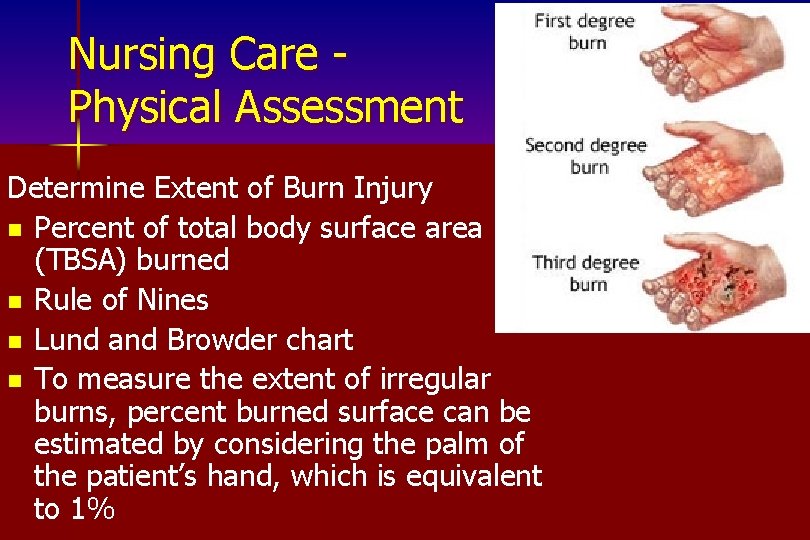 Nursing Care Physical Assessment Determine Extent of Burn Injury n Percent of total body
