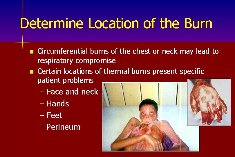 Determine Location of the Burn n n Circumferential burns of the chest or neck