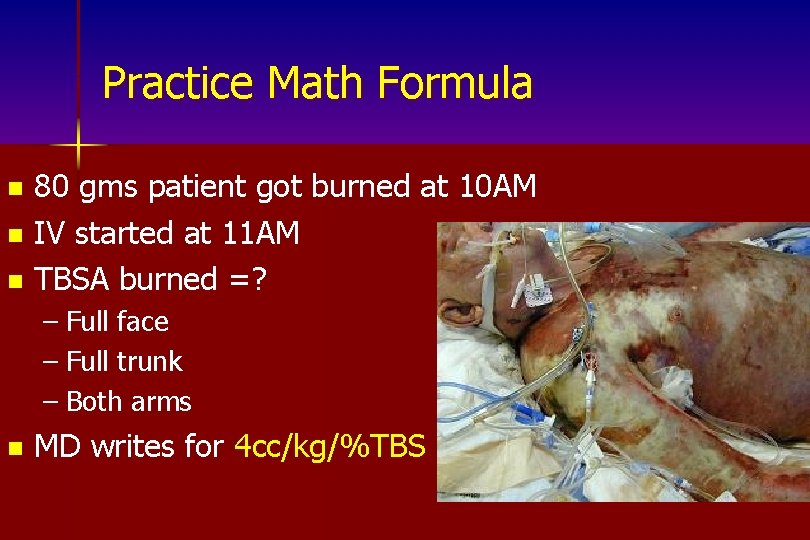 Practice Math Formula 80 gms patient got burned at 10 AM n IV started