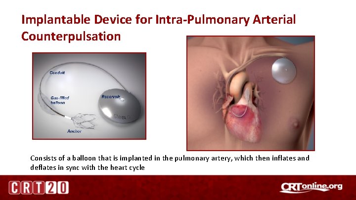 Implantable Device for Intra-Pulmonary Arterial Counterpulsation Consists of a balloon that is implanted in