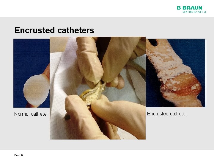 Encrusted catheters Normal catheter Page 12 Encrusted catheter 